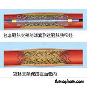 生物降解镁合金支架